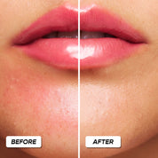 KISSING RASH REMEDY